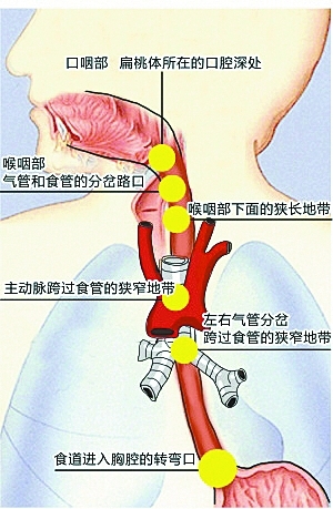 男子魚刺卡喉身亡 醫(yī)生: 吞飯喝醋等土方法更要命