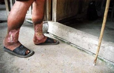 Jiang Hongcai, 81, whose feet have rotten due to an anthrax fungus infection, walks with the help of a crutch at his home in Jinhua, east China's Zhejiang province, July 5, 2005.