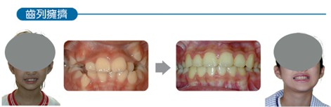 口腔專家何啟洸：牙齒矯正 越早越好