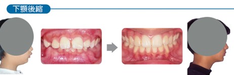 口腔專家何啟洸：牙齒矯正 越早越好