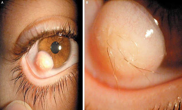 眼球上長毛發(fā)！伊朗小伙眼部奇異囊腫恐怖駭人