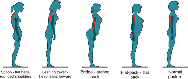 你是“勺形”還是“橋形”？站姿決定背痛與否