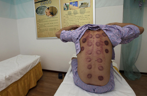 Traditional Chinese cupping treatment