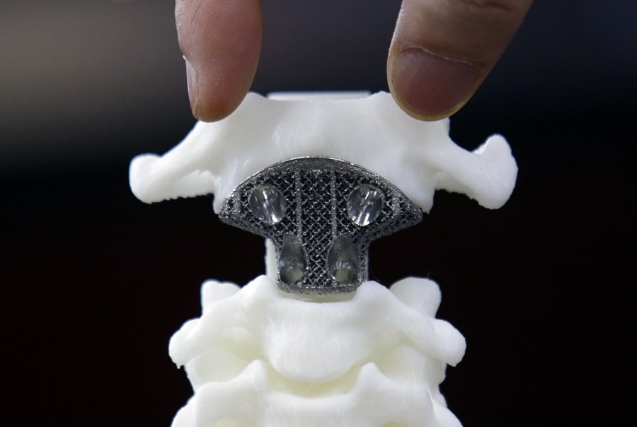 First 3D-printed artificial axis in China